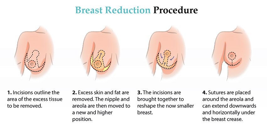 breast reduction