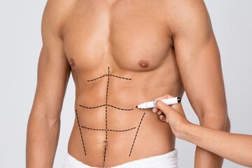 liposuction-and-abs-16543333023x2